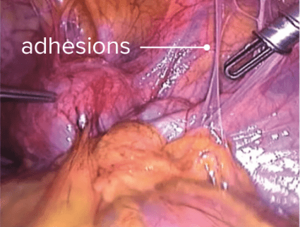 Endometriosis adhesions